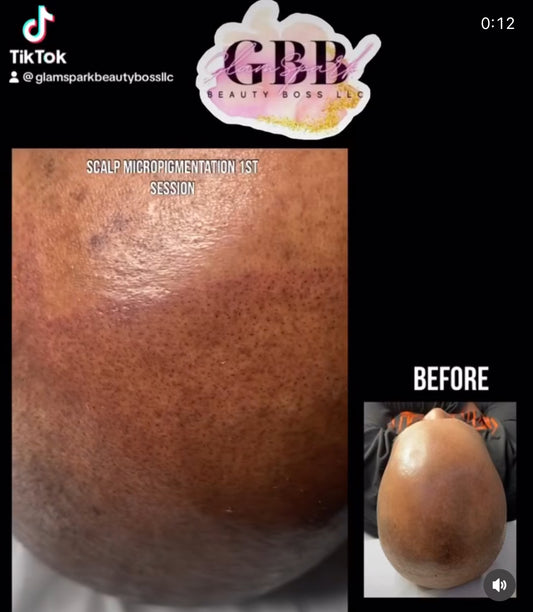SMP Scalp Micropigmentation