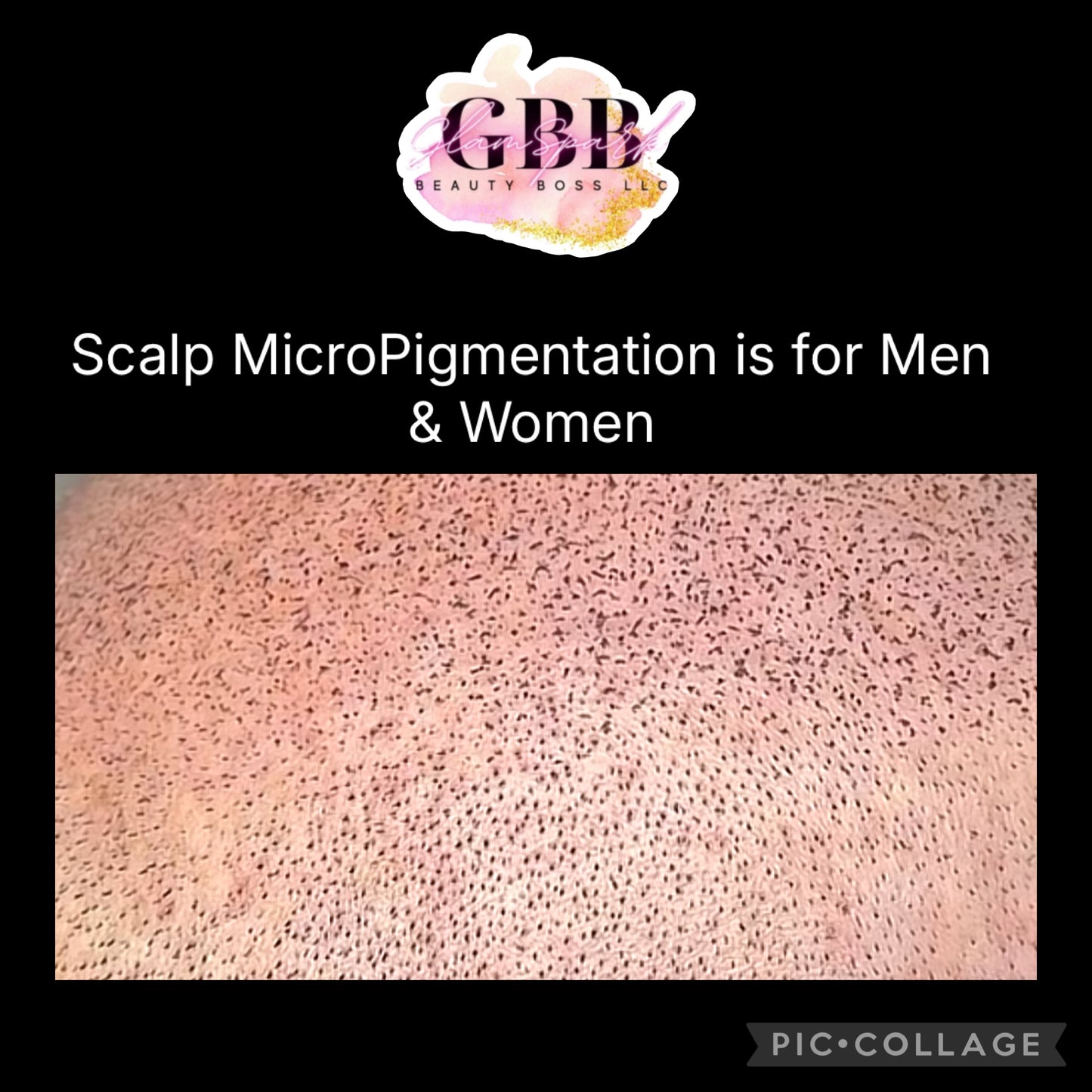 SMP Scalp Micropigmentation