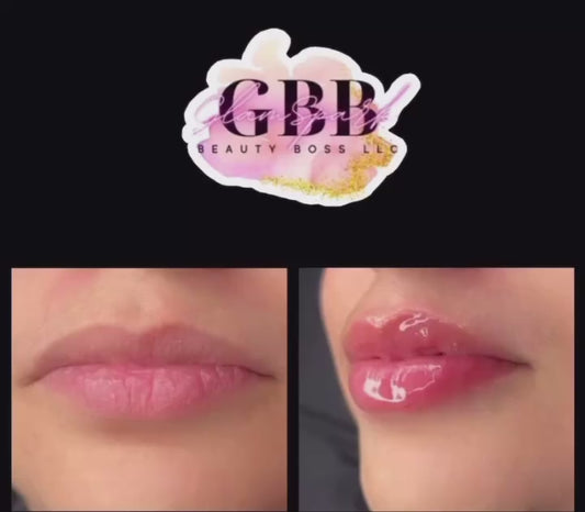 1 ML Lip Filler